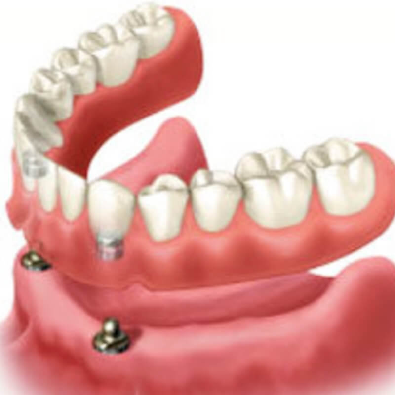 Implant Supported Full Denture - Geelong West Dental