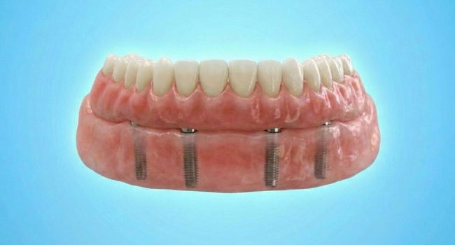 <br />
All-on-4 dental implants showing a full arch of prosthetic teeth securely fixed to four titanium implants.