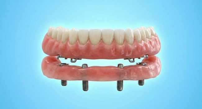 <br />
An implant-retained full denture system showing how a prosthetic arch connects to four dental implants.