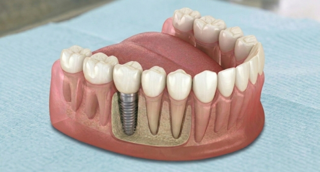 <br />
A completed dental implant restoration showing the crown and screw integrated into the jaw for improved form and function.