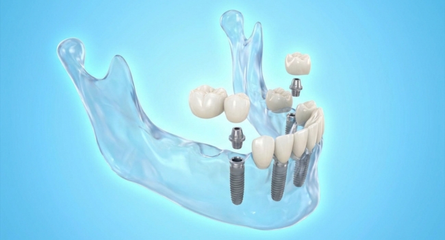 <br />
A 3D model showing multiple dental implants and porcelain crowns being fitted into a clear jawbone structure.
