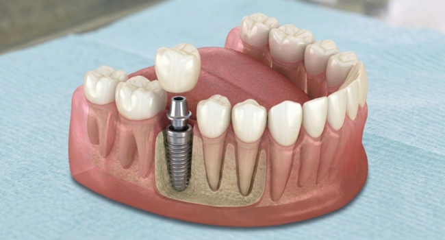 <br />
Diagram showing a dental implant and crown being fitted into the jaw while preserving the adjacent healthy teeth.