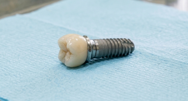 <br />
A molar crown attached to a dental implant screw on a blue clinical surface for targeted tooth replacement.